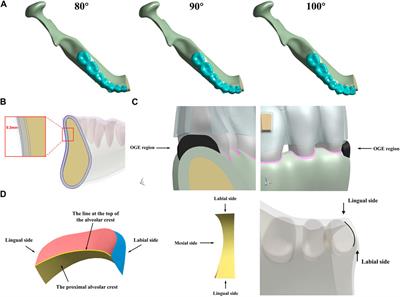 Biomechanical factors in the open gingival embrasure region during the intrusion of mandibular incisors: A new model through finite element analysis